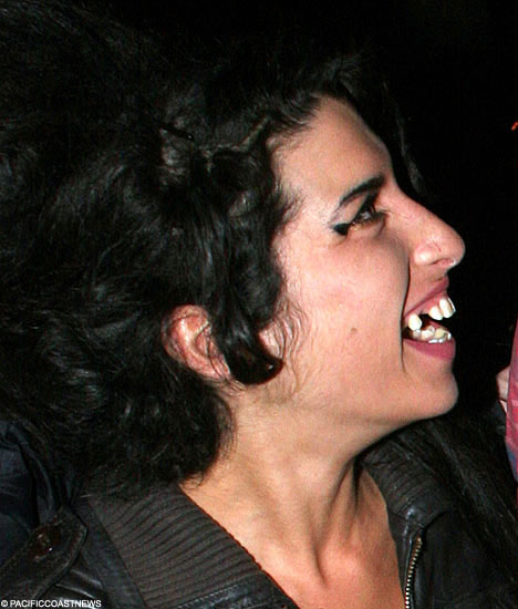 Amy Winehouse has meth teefs