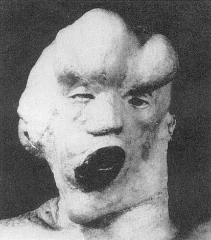 John Merrick, The Elephant Man