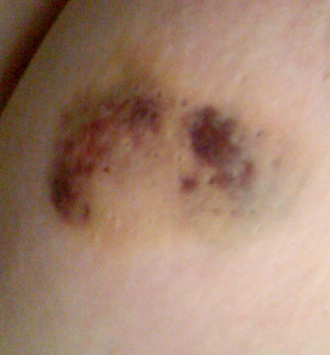 The Damage and yes, it hurt about as much as it looks like it hurt like